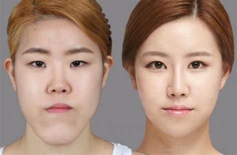 best plastic surgeons in korea.